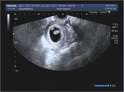 Spontaneous pregnancy after tracking ovulation during menstruation: A case report of a woman with premature ovarian insufficiency and repeated failure of in vitro fertilization